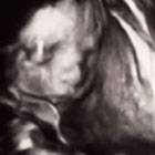 3D Ultraschall